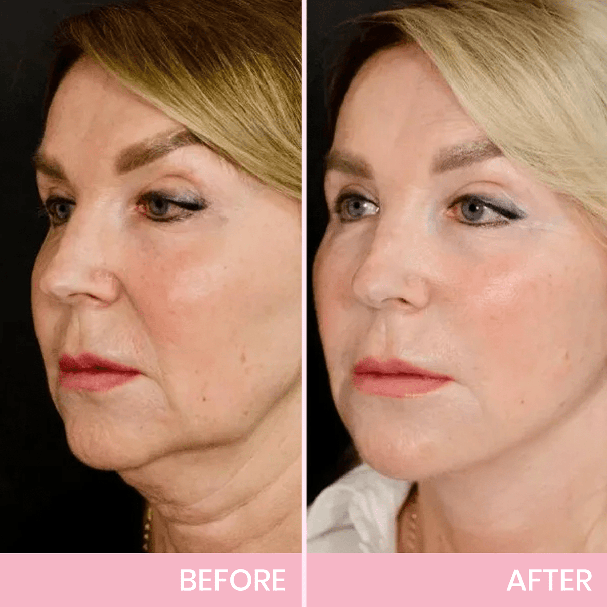 💖🎁Posledný deň so zľavou 50 % – neviditeľná lepiaca páska Aweiya™ V-Face Lifting