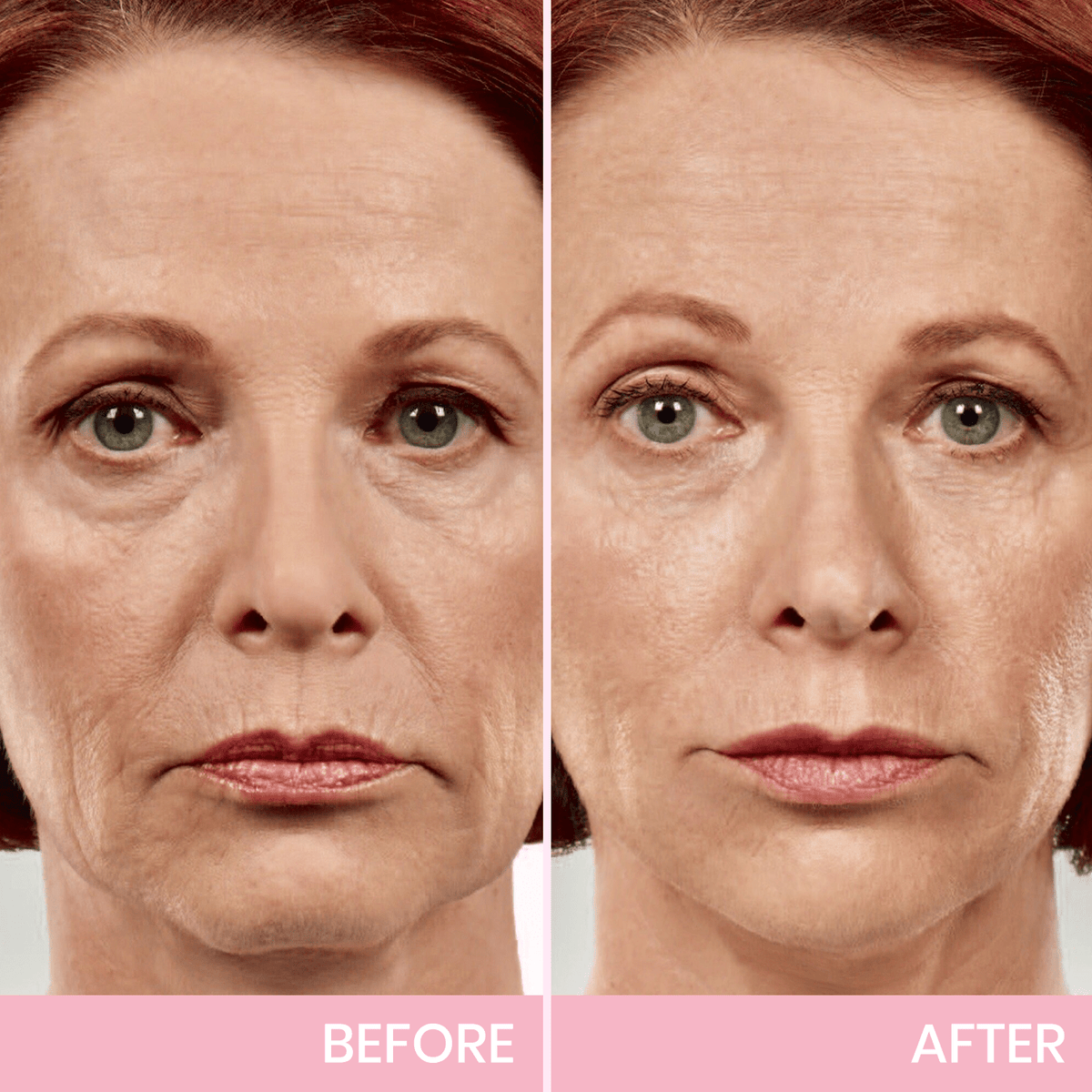 💖🎁Posledný deň so zľavou 50 % – neviditeľná lepiaca páska Aweiya™ V-Face Lifting