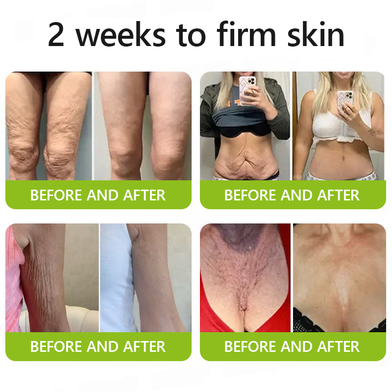 [🔥Posledný deň so 70% zľavou] ODALIT™ Botox a retinolový injekcia - redukuje hlboké vrásky, ochabnuté líce a opuchnuté oči